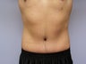 Tummy tuck for a male