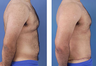 Tummy tuck on a male age 24
