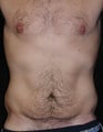 Male tummy Tuck, Flank Liposuction, Male Breast Reduction