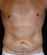 Male tummy Tuck, Flank Liposuction