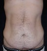 Male tummy Tuck