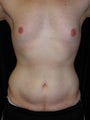 Male Tummy Tuck, Flank Liposuction, Male Breast Reduction