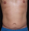 Male tummy Tuck, Flank Liposuction