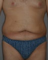 Male Abdominoplasty
