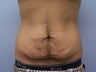 Tummy tuck for a male