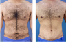 Tummy tuck on a male age 24