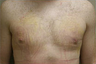 Male Breast Reduction