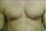 Male Breast Reduction