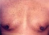 Male Breast Reduction