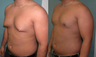 Male Breast Reduction