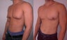 Male Breast Reduction