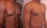 Male Breast Reduction