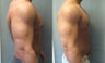 Male Breast Reduction