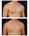 Gynecomastia
