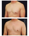 Gynecomastia