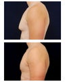 Gynecomastia