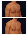Gynecomastia 