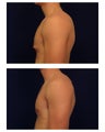 Gynecomastia 