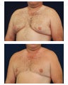 Gynecomastia