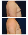 Gynecomastia