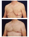 Gyencomastia