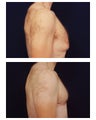 Gynecomastia