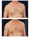 Gynecomastia