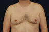 Gynecomastia