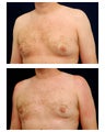 Gynecomastia