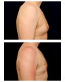 Gynecomastia