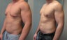 Gynecomastia 