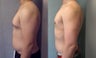 Gynecomastia 