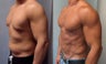 Gynecomastia 