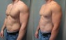 Gynecomastia 