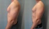 Gynecomastia 