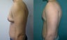  Gynecomastia 