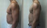 Gynecomastia 