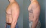  Gynecomastia 