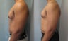 Male Breast Reduction 
