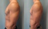 Gynecomastia 