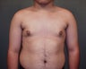 Male Breast Reduction