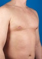 Gynecomastia 