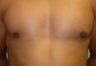 Male Breast Reduction