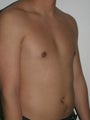 Male Breast Reduction