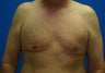 Male Breast Reduction (Gynecomastia Treatment)