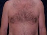 Liposuction and ultra-sonic liposuction to the chest for gynecomastia