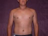 gynecomastia treatment