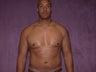gynecomastia treatment