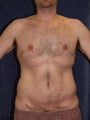 Male Breast Reduction - Gynecomastia