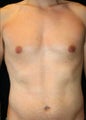 Male Breast Reduction